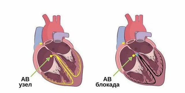 Блокады сердца презентация