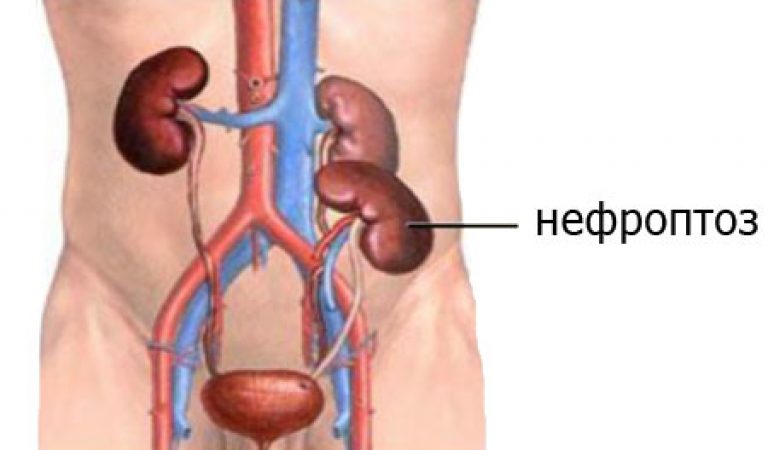 Какой нужен бандаж при опущении почек? | медицинские товары и медтехника в магазине Ортосалон