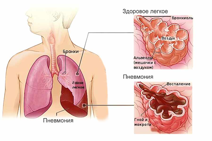 Берут ли в армию с пневмонией?