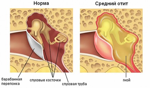 Служба в армии и отит